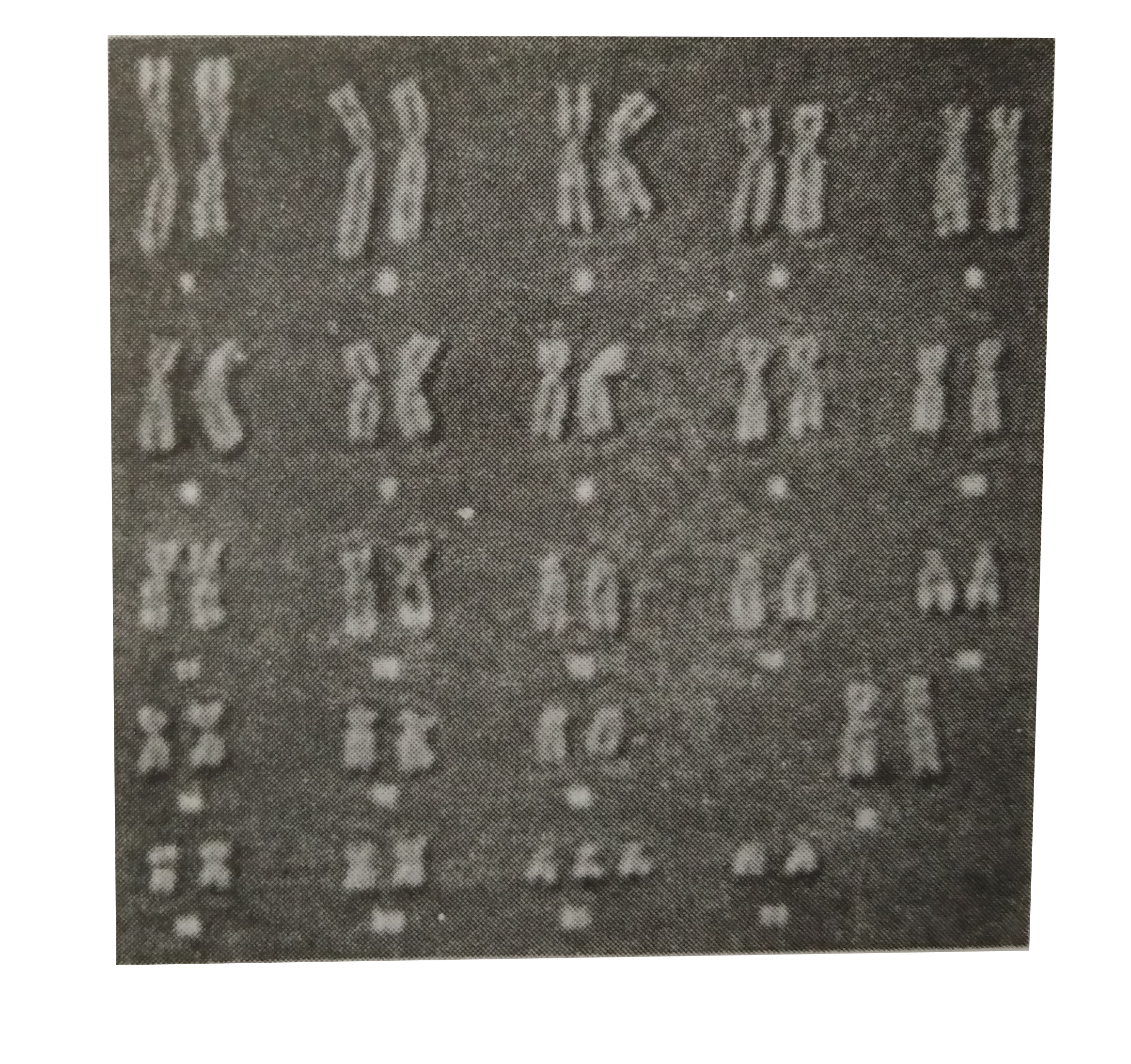 The chromosomal pattern of individual is shown here.    This individual is suffering from