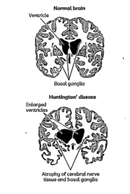 Read the following excerpt. On the basis of your reading, answer the given question:    Huntington disease can lead to uncontrolled movements, emotional problems, and loss of thinking ability (cognition). It is a progressive brain disorder caused by a single defective gene on chromosome number 4 - one of the 23 human chromosomes.        Its an autosomal dominant disorder