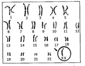 The above figure shows the karyotype of: