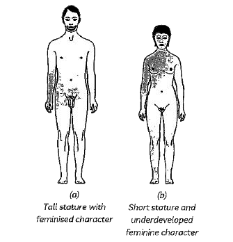 Observe the figure given below and answer the question that follows:      The given individuals might be suffering from: