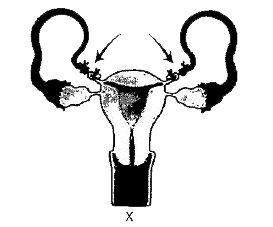 Which of the following statements are true related to X?      (I) X involves blocking of gamete transport.   (II) In X, a small part of the vas deferens is removed or tied up.   (III) X prevents conception with the help of a surgical intervention.   (IV) X is easily reversible.