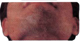 चित्र त्वचा के दाद प्रभावित क्षेत्र को दर्शा रहे है, बताइये कि निम्न में से कौनसा रोगजनक इस रोग से सम्बंधित नहीं है?