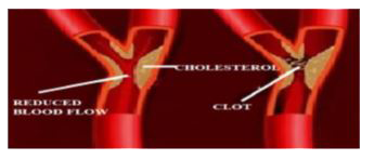 A patient admitted in ICU was diagnosed to have suffered from myocardial infarction. The condition of coronary artery is depicted in the image below.     Name  two bioactive agents and their mode of action that can improve this condition.