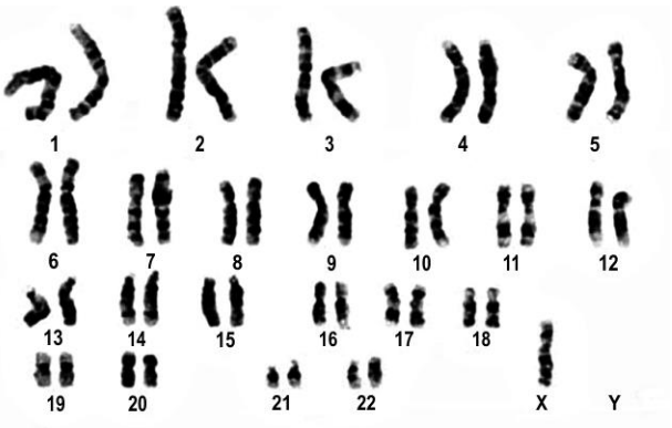 Given below is the karyotype of an individual.      (a) What are the characteristic reproductive and physical features of such an individual?
  (b) What is the category of such disorders called? How is it caused?