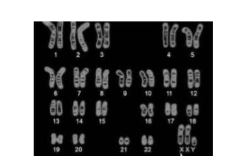 Study the human karyotype given below.       Which among the following does the karyotype represent?