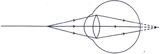 Observe the following diagram showing an image formation in an eye:   (a)Identify the defect of vision shown in the figure. (b)List its two causes and suggest a suitable corrective lens to overcome this defect.