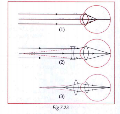 Answer the question based on the following diagrams:   Name the defect shown in figure(1)