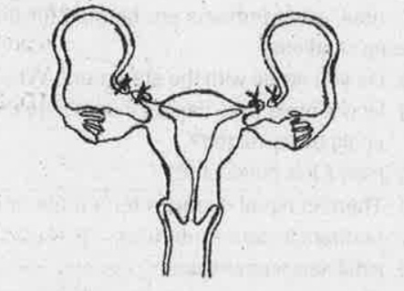 Diagram shown below is a surgical method used for female sterilization.   What Is th surgical method of male sterilization called?