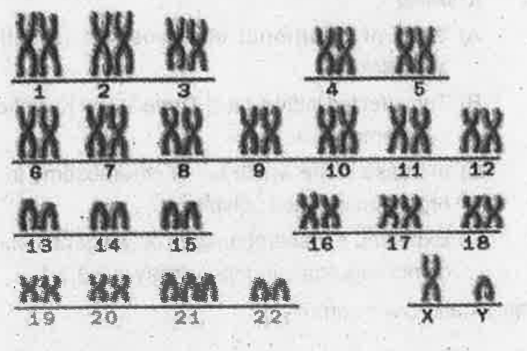 Karyotype of human chromosome compliment Is given below. it has some abnormally.   Mention any one consequence of this abnormality.