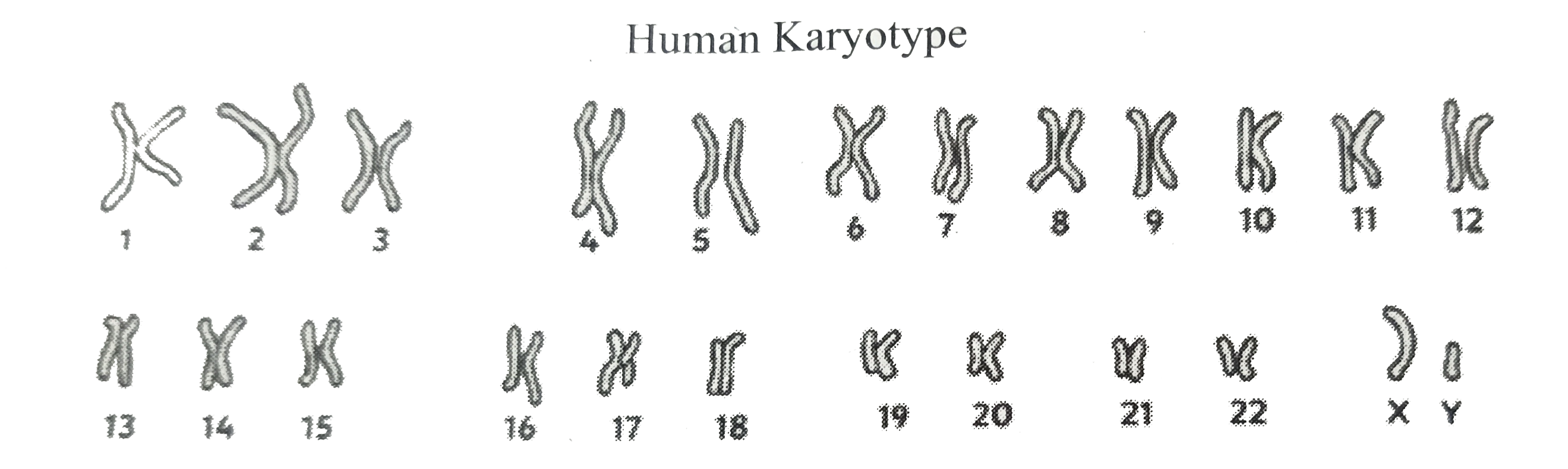 Given below represents the human karyotype of male. Notify the abnormality and mention any two symptoms of the respective abnormality.