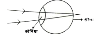 चित्र में आँख की बनावट का एक सरलीकृत स्वरुप दिया गया है , जिसमे आँख पर आपतित पूरे प्रकाश के अपवर्तन को कॉर्निया से होता माना जाता है। कॉर्निया आँख का सबसे अगला भाग है , जो लगभग 2 सेमी के एक नियत फोकस दूरी वाली अभिसारी लेंस होता है। अनन्त से आनेवाली समानान्तर किरणें कॉर्निया से अपवर्तित होकर रेटिना पर फोकसित प्रतिबिम्ब बनाती है। रेटिना प्रतिबिम्ब बनने की सूचना को प्रकाश तंत्रिका के माध्यम से मस्तिष्क तक पहुँचाती है।   निकट दिष्टि दोष एवं दूर दोष आँख में होने वाले दो समान्तर बीमारियाँ है। निकट दिष्टि दोष या मायोपिया में दूर से आने वाली किरणें कॉर्निया से अपवर्तन के बाद दूरस्थ वस्तु का प्रतिबिम्ब रेटिना के सम्मुख बना देती है।  दूर दिष्टि दोष या हाइपरोपिया में नजदीक की वस्तु का प्रतिबिम्ब कॉर्निया से अपवर्तन के बाद रेटिना से पीछे बनता है।  दोनों दोषों  को दूर करने के लिए उपयुक्त फोकस दूरी एवं प्रकृति का लेंस प्रयोग किया जाता है।  कॉर्निया तथा प्रयुक्त लेंस का संयुक्त समूहन प्रतिबिम्ब को पुनः रेटिना पर ले आता है। यदि दूर की वस्तु को अनन्त पर मान जाए तब कॉर्निया से प्रतिबिम्ब की दूरी को निम्नलिखित सूत्र से ज्ञात किया जा सकता है :   (1)/(fc)+(1)/(f(1)-x)=(1)/(v),f(c)= कॉर्निया की फोकस - दूरी   f(1)= संशोधी लेंस की फोकस - दूरी   x= कॉर्निया एवं अतिरिक्त लेंस के बीच की दूरी   निकट दिष्टि एवं दूरी दिष्टि दोष को दूर करने के लिए क्रमशः किस प्रकृति का लेंस उपयोग किया जाना चाहिए ? [ मान लें कि f(c)=x]