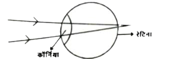 चित्र में आँख की बनावट का एक सरलीकृत स्वरुप दिया गया है , जिसमे आँख पर आपतित पूरे प्रकाश के अपवर्तन को कॉर्निया से होता माना जाता है। कॉर्निया आँख का सबसे अगला भाग है , जो लगभग 2 सेमी के एक नियत फोकस दूरी वाली अभिसारी लेंस होता है। अनन्त से आनेवाली समानान्तर किरणें कॉर्निया से अपवर्तित होकर रेटिना पर फोकसित प्रतिबिम्ब बनाती है। रेटिना प्रतिबिम्ब बनने की सूचना को प्रकाश तंत्रिका के माध्यम से मस्तिष्क तक पहुँचाती है।   निकट दिष्टि दोष एवं दूर दोष आँख में होने वाले दो समान्तर बीमारियाँ है। निकट दिष्टि दोष या मायोपिया में दूर से आने वाली किरणें कॉर्निया से अपवर्तन के बाद दूरस्थ वस्तु का प्रतिबिम्ब रेटिना के सम्मुख बना देती है।  दूर दिष्टि दोष या हाइपरोपिया में नजदीक की वस्तु का प्रतिबिम्ब कॉर्निया से अपवर्तन के बाद रेटिना से पीछे बनता है।  दोनों दोषों  को दूर करने के लिए उपयुक्त फोकस दूरी एवं प्रकृति का लेंस प्रयोग किया जाता है।  कॉर्निया तथा प्रयुक्त लेंस का संयुक्त समूहन प्रतिबिम्ब को पुनः रेटिना पर ले आता है। यदि दूर की वस्तु को अनन्त पर मान जाए तब कॉर्निया से प्रतिबिम्ब की दूरी को निम्नलिखित सूत्र से ज्ञात किया जा सकता है :   (1)/(fc)+(1)/(f(1)-x)=(1)/(v),f(c)= कॉर्निया की फोकस - दूरी   f(1)= संशोधी लेंस की फोकस - दूरी   x= कॉर्निया एवं अतिरिक्त लेंस के बीच की दूरी   एक व्यक्ति के कॉर्निया की फोकस दूरी 1.8 सेमी है , तथा वह दिष्टीदोष से मुक्त हेतु एक f=-16.5 सेमी के संशोधी लेंस को आंख के कॉर्निया से x=1.5 सेमी की दूरी पर उपयोग करता है।  ऐसी स्थिति में दूरस्थ वस्तु से आने वाली किरणों का कॉर्निया से प्रतिबिम्ब दूरी होगी :