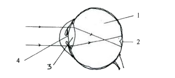 Given below is a diagram depicting a defect of the human eye.  Study the same and then answer the questions that follow:      Draw a labelled diagram to show how the above mentioned defect is rectified using an appropriate lens.