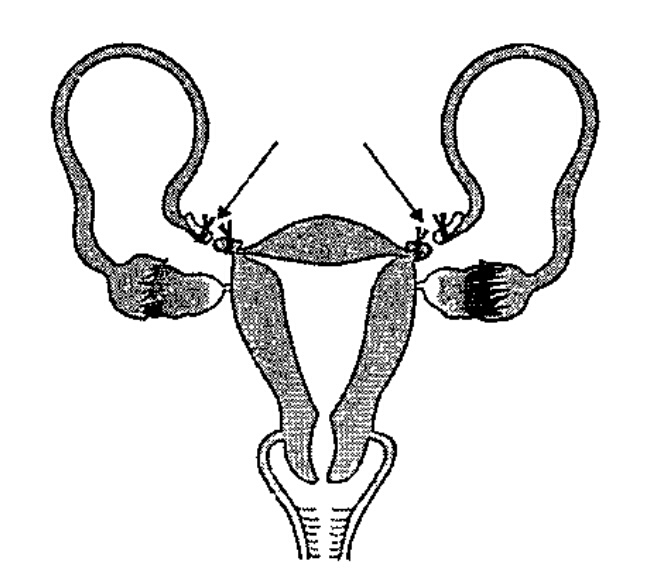 Which structure is removed in this figure?