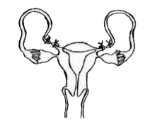 Diagram shown below is a surgical method used for female sterilization.      a. What is the method shown in diagram ?   b. Mention any two intra uterine devicesd to prevent conception.   c. What is the surgical method of male sterilization called ?