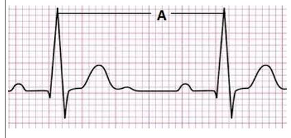 Identify ‘A’ from the following ECG.