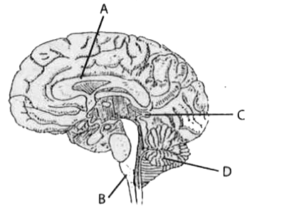 नीचे दिया गया चित्र मानव मस्तिष्क की काट का है। नामांकित भागों का दिये गये कथनों से मेल करें और सही विकल्प चुनें।   (i) फाइबर ट्रैक्ट्स पाए जाते हैं जो दायें और बायें हेमीस्फीयर को जोड़ते हैं।    (ii) एक हार्मोन मेलाटोनिन स्रावित करता है   (iii) अल्कोहल इस भाग के कार्य को प्रभावित करता है।   (iv) ऐसे केन्द्र स्थित होते हैं जो श्वसन, कार्डियोवस्कुयलर प्रतिवर्ती और जठरीय स्रावण की नियंत्रित करते हैं।
