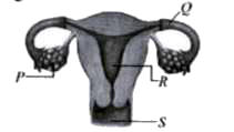 Refer to the given figure. Identify P-S and select the correct statements regarding them.   (i) If both P are surgically removed from a female's body then she wil not menstruate but can still produce eggs.  (ii) R is a very small organ in a female which serves as a site of formation, implantation and further development of zygote.      (iii) When embryo implants and develops in Q, it is removed by medication or invasive surgical procedures as it could be life threatening for mother.   (iv) Labelled part S receives sperms and also serves as birth canal.
