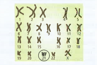 Refer to the given figure representing karyotype of individual who inflicted with this chromosomal disorder      Select  the correct statement   regarding them.