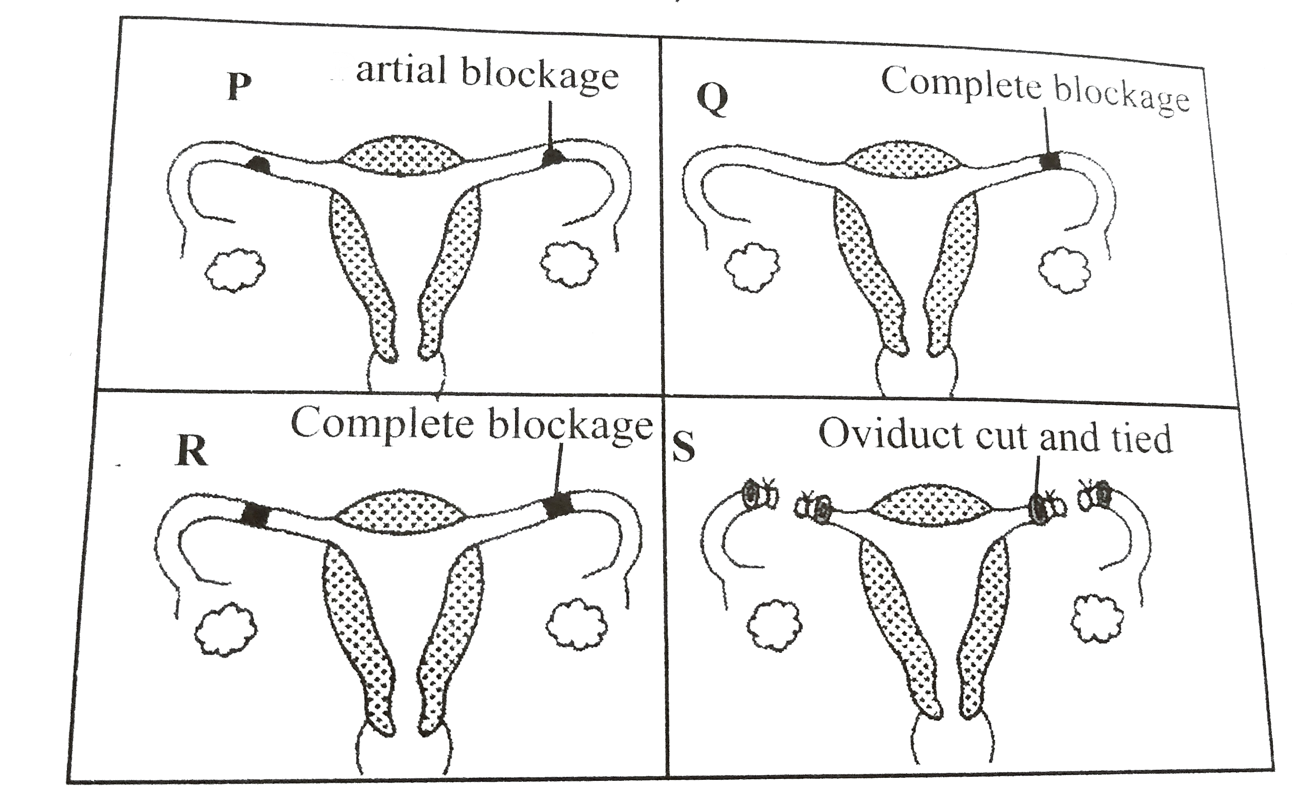 The accompanying diagram shows the uterine tubes of four women (P,Q,R and S)      In which two women is fertilisation impossible at present ?