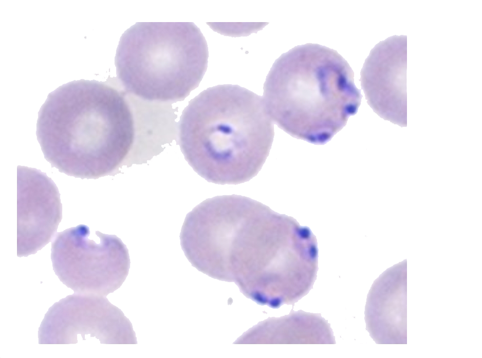 A patient blood smear show the following picture. Which disease is the patient suffering from ?