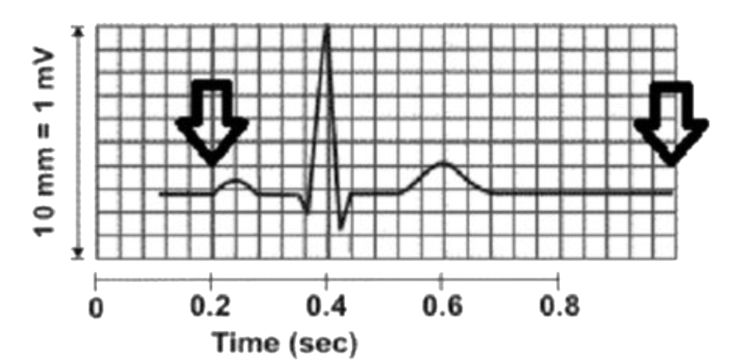 The following diagram is what a nurse saw on a patient's ECG trace, which measures the electrical impulse passed by the heart in one heartbeat. The first arrow on the left signifies the beginning of the beat and the second arrow on the right signifies the end of the beat   How many beats per minute did the nurse find in this patient?    (a) 100 

(b) 75 

(c) 60 

(d) 54