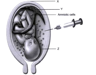 Read the details and answer the questions that follow: A technique known as amniocentesis is used to determine fetal abnormalities. This test is based on the chromosomal pattern in amniotic fluid. However, this technique is legally banned now.      Abortion can be safely done for aboutweeks of pregnancy.