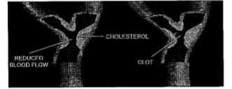 A patient admitted in ICU was diagnosed to have suffered from myocardial infarction. The condition of  coronary artery is depicted in the image below. Name two bioactive agents and their mode of action that can improve this condition.