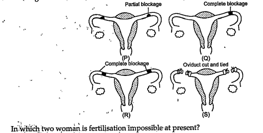 The diagram shows the uterine tubes of four woman (P,Q,R and S).