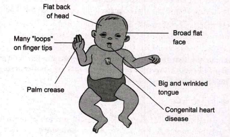 This child is affected by which of the following genetic disease?