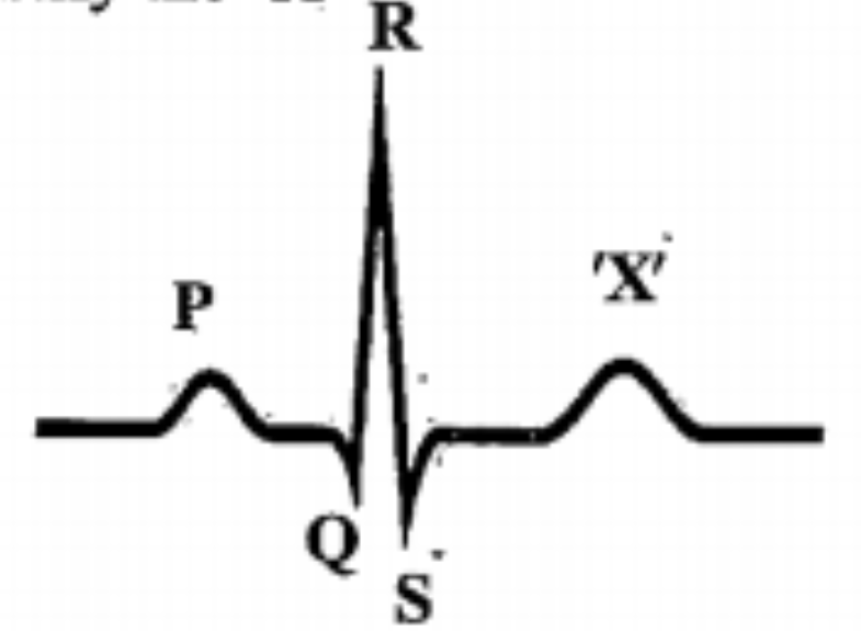 Given below is the diagrammatic representation of a standard ECG Identify the 'X'