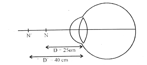 एक दीर्घ दृष्टि दोषयुक्त नेत्र के निकट बिन्द N' व सामान्य नेत्र के निकट बिन्दु की स्थितियाँ निम्न चित्रानुसार अंकित हैं। दोष निवारण के लिए प्रयुक्त लैंस की क्षमता तथा प्रकृति ज्ञात कीजिए।