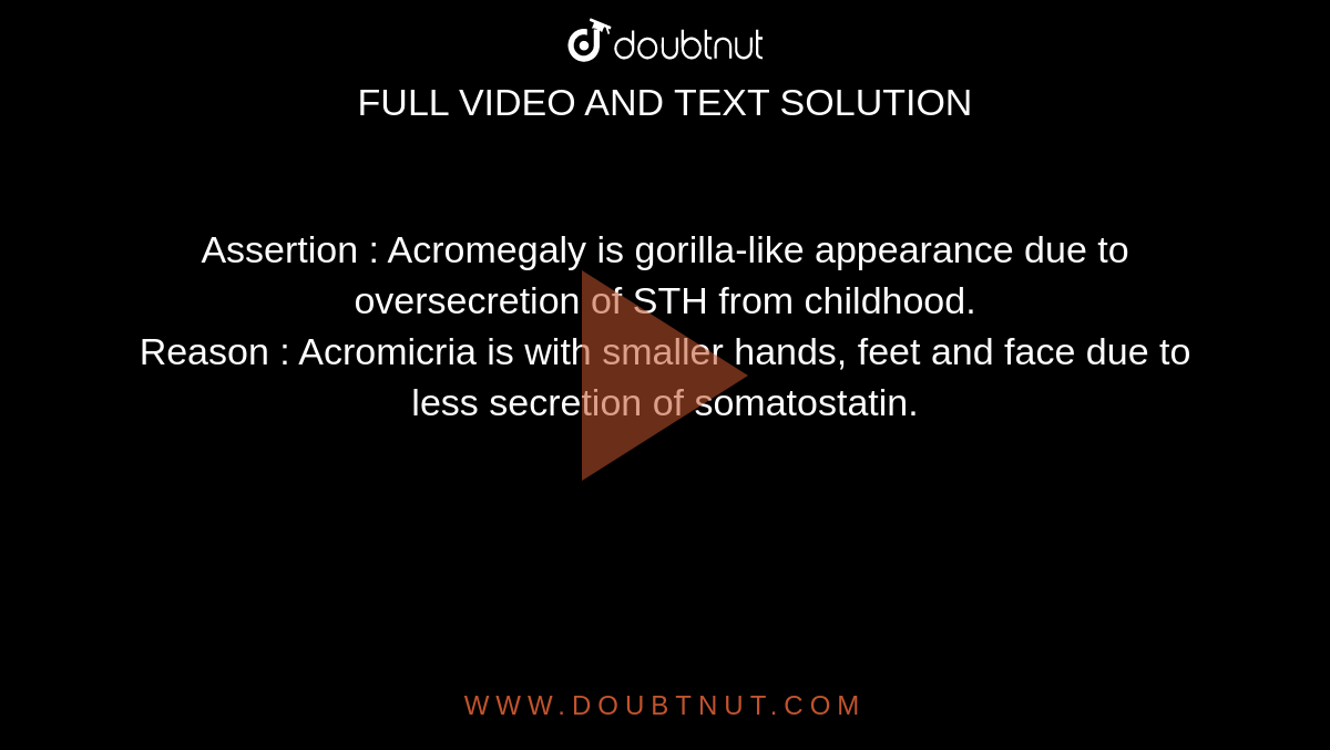 Assertion : Acromegaly is gorilla-like appearance due to oversecretion of STH from childhood. <br> Reason : Acromicria is with smaller hands, feet and face due to less secretion of somatostatin.